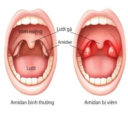 PHÂN BIỆT: VIÊM AMIDAN  VÀ VIÊM HỌNG LIÊN CẦU KHUẨN