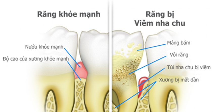 Tại sao bị bệnh nha chu