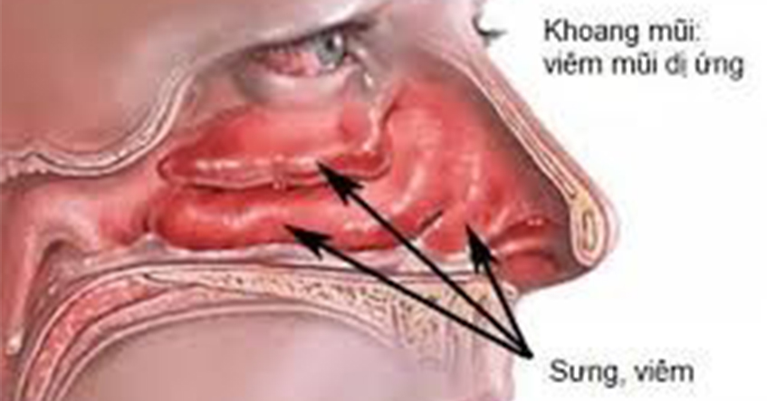 Các bệnh về Mũi thường gặp