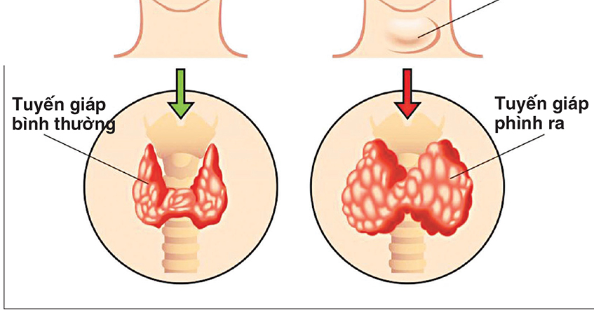 Nguyên nhân và triệu chứng bệnh bướu cổ