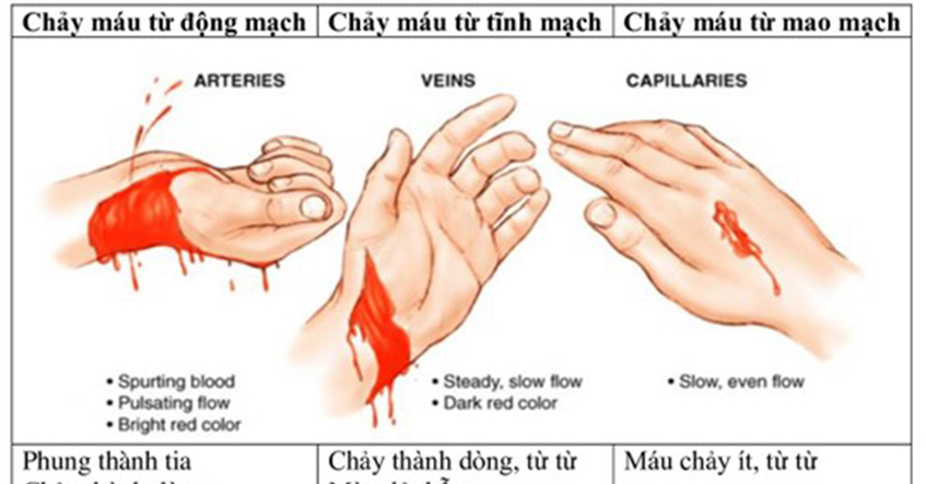 MỘT SỐ PHƯƠNG PHÁP CẦM MÁU TẠI NHÀ