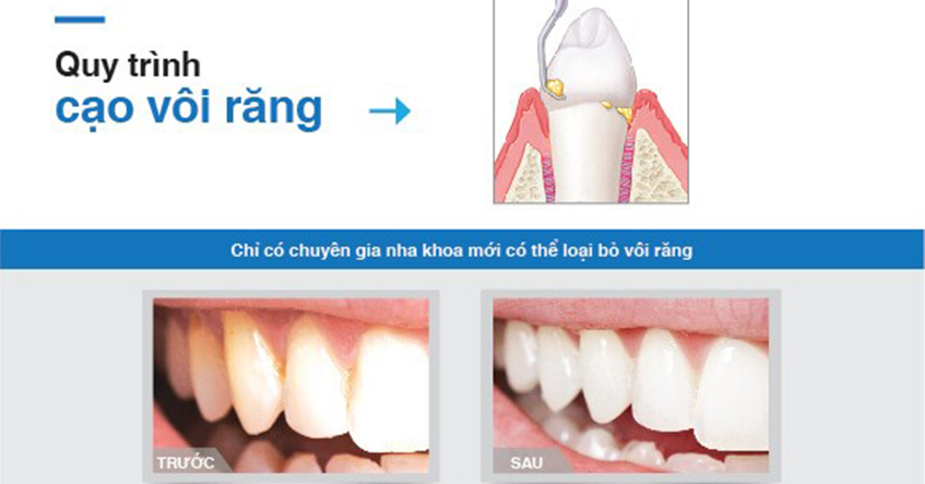 TÁC HẠI VÀ CÁCH PHÒNG NGỪA CAO RĂNG