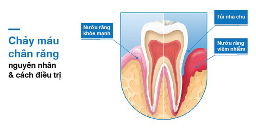 CHẢY MÁU CHÂN RĂNG DO ĐÂU VÀ ĐIỀU TRỊ NHƯ THẾ NÀO