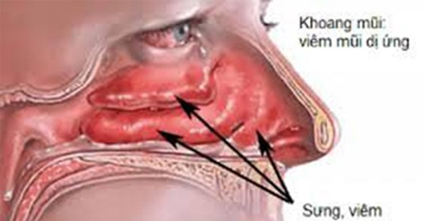 DỊ ỨNG VÀ NHỮNG ĐIỀU CẦN BIẾT