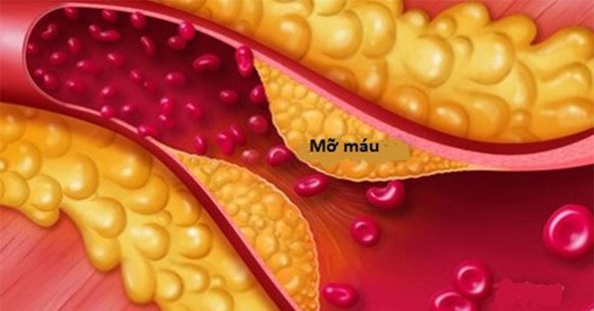 10 CÁCH GIÚP GIẢM CHOLESTEROL TRONG CHẾ ĐỘ ĂN HÀNG NGÀY