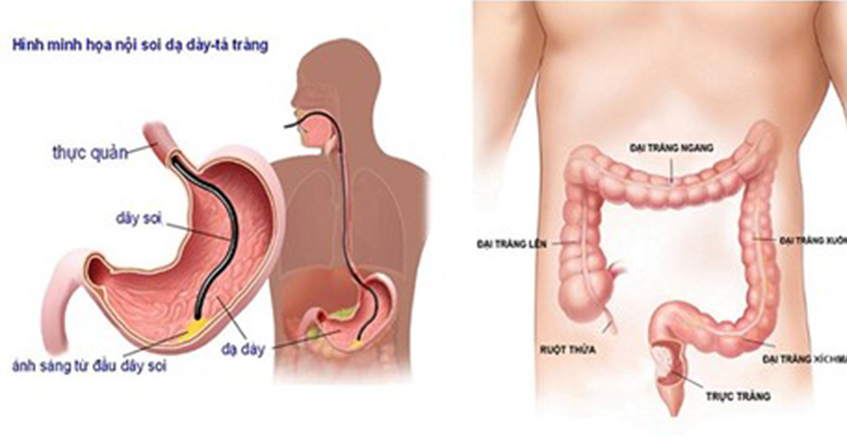 SIÊU ÂM NỘI SOI (EUS) BƯỚC TIẾN TRONG Y HỌC & NHỮNG ĐIỀU CẦN BIẾT