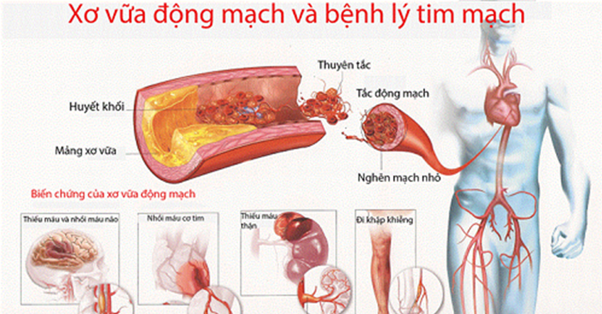 Nguyên nhân và triệu chứng gây xơ vữa động mạch vành