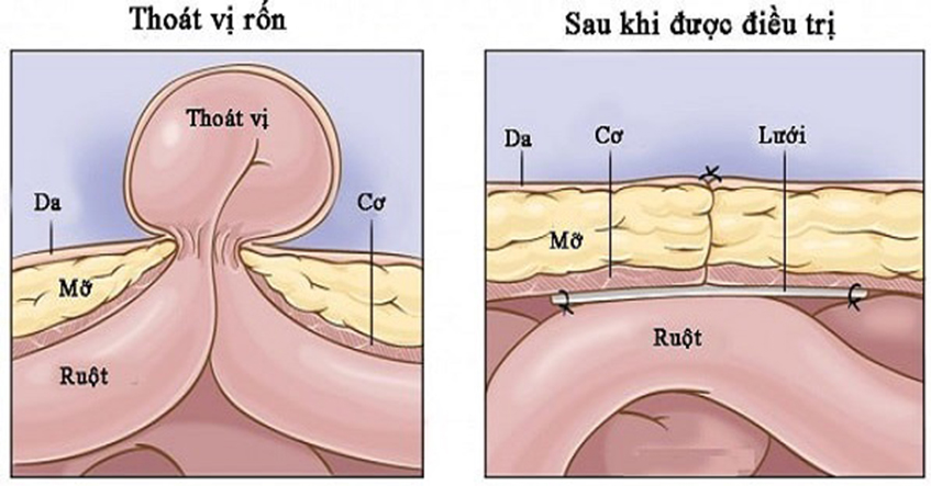 NHỮNG ĐIỀU CẦN LƯU Ý VỀ THOÁT VỊ RỐN Ở TRẺ SƠ SINH