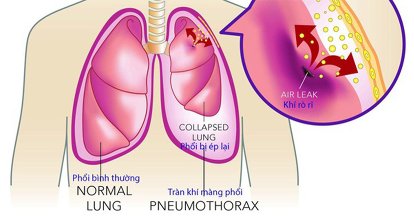 NGUYÊN NHÂN VÀ TRIỆU CHỨNG TRÀN KHÍ MÀNG PHỔI