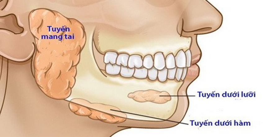 NGUYÊN NHÂN VÀ ĐIỀU TRỊ BỆNH U LÀNH TÍNH VÙNG XƯƠNG HÀM