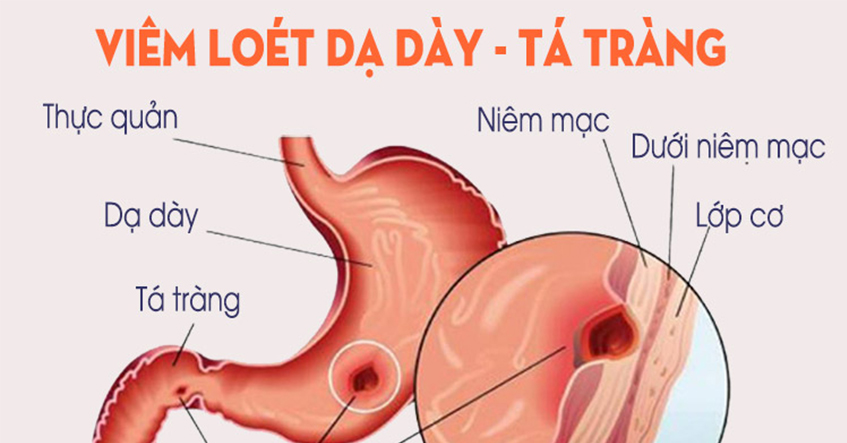 Nguyên nhân và triệu chứng của bệnh viêm dạ dày