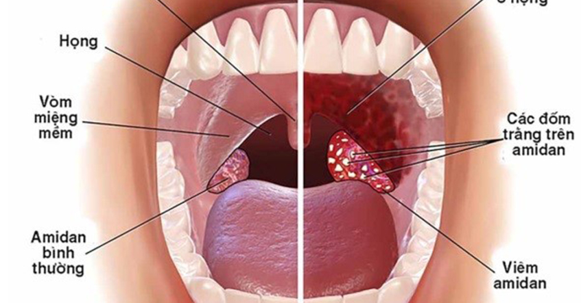 Triệu chứng và nguyên nhân bệnh viêm họng