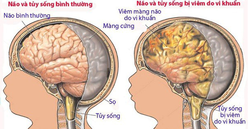 Nguyên nhân và  triệu chứng Viêm màng não