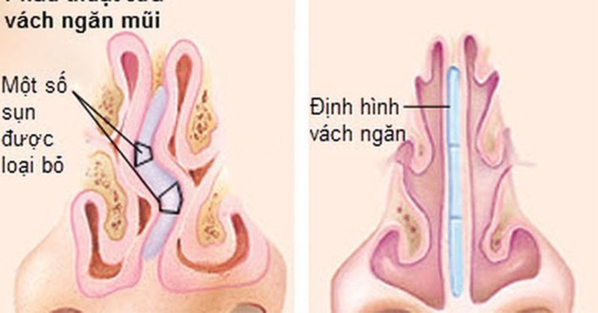 4 LOẠI THỰC PHẨM NÊN TRÁNH KHI BỊ VIÊM XOANG