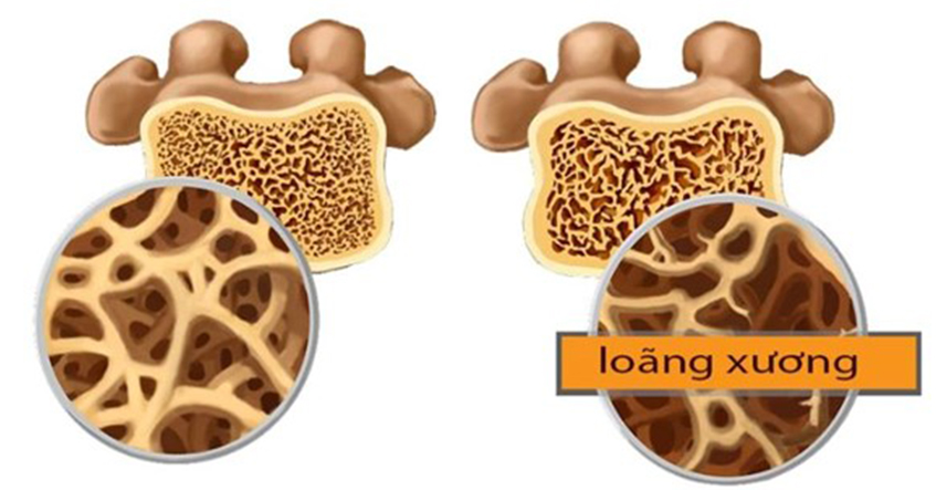 LOÃNG XƯƠNG: NGUYÊN NHÂN, TRIỆU CHỨNG, ĐIỀU TRỊ & HƠN THẾ NỮA