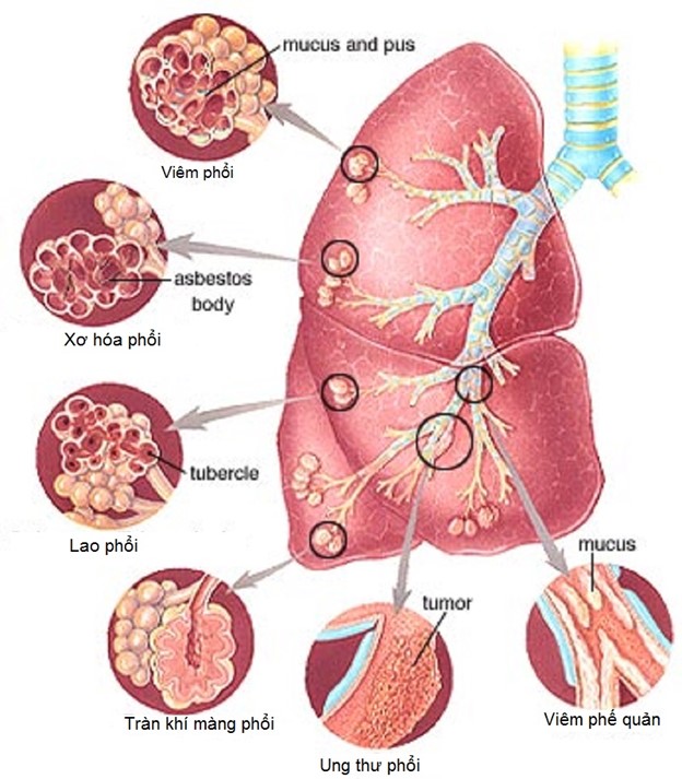 Nguyên nhân và triệu chứng suy hô hấp cấp tính ở người lớn - Trung Tâm Y Khoa Pasteur Đà Lạt